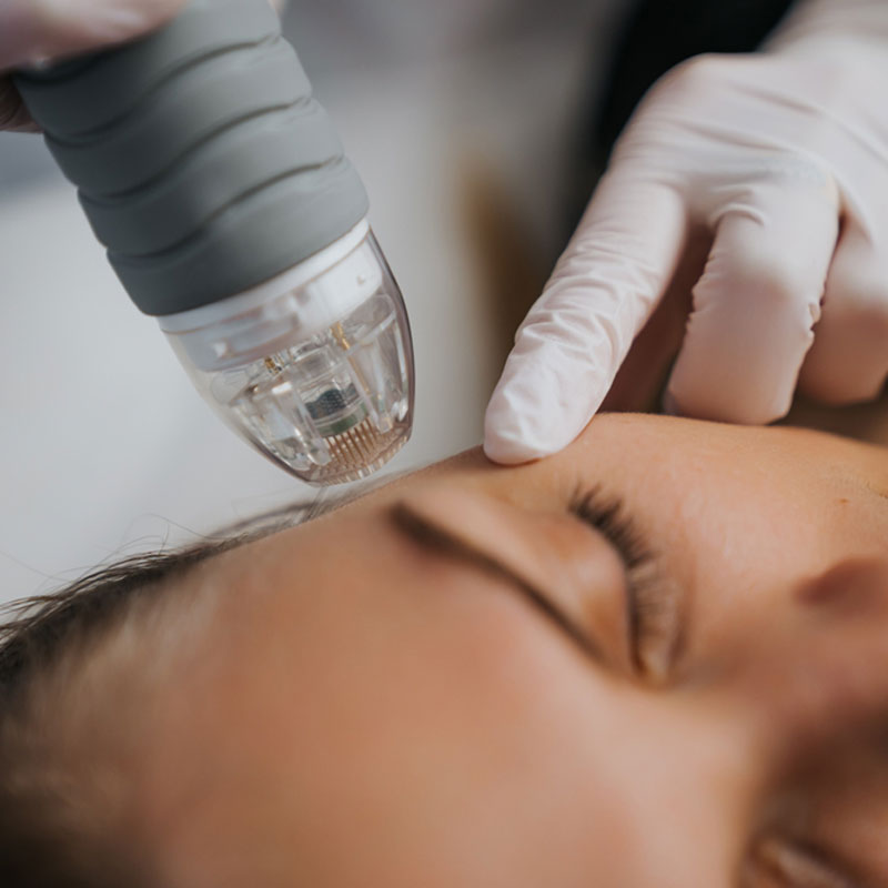 RF Micro-Needling | Bonita Springs, FL | Facial Esthetique MedSpa